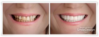 cosmetic dentist bakersfield Bakersfield Smile Design: Dr. Kenneth W Krauss DDS
