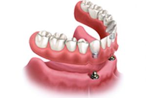 dental implants periodontist garden grove Seal Beach Dental Implants and Periodontics
