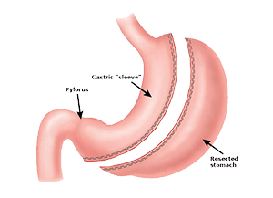 bariatric surgeon inglewood The Weight Loss Surgery Center of Los Angeles