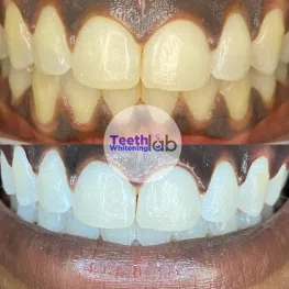 teeth whitening service long beach Teeth Whitening Lab Long Beach