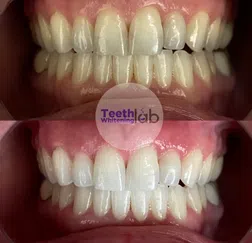teeth whitening service long beach Teeth Whitening Lab Long Beach