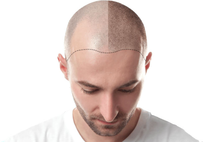 hair replacement service oceanside Coast SMP: Scalp Micropigmentation & Hair Loss Solutions