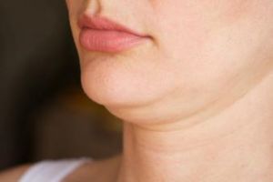 Almost nobody likes having a double chin, but there’s something you can do about it. Learn about a treatment called Kybella and how it can rid you of that double chin.