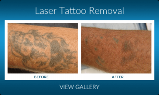 tattoo removal service roseville Laser Esthetica