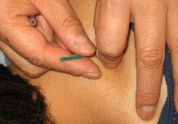 acupuncturist roseville Village Acupuncture - Center for Optimum Health