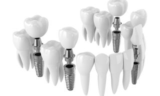 dental implants provider roseville Fusion Dental Implants