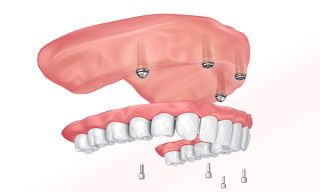 dental implants provider roseville Fusion Dental Implants
