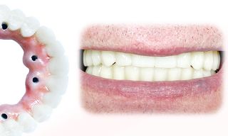 This is your unique chance to get a new full-arch dental restoration, which not only looks great but also performs like the original one.