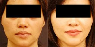plastic surgeon san jose Chase Lay, MD | Facial Plastics & Asian Eyelid Surgery