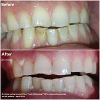 teeth whitening service san jose Crystal Clear Teeth Whitening