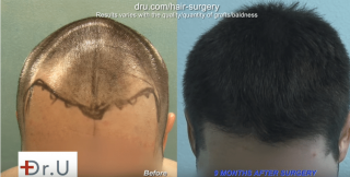 hair transplantation clinic torrance DERMHAIR CLINIC