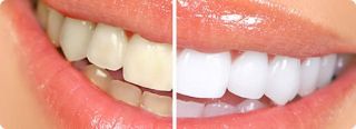 teeth whitening service vallejo Cervantes & Prado Dental Care