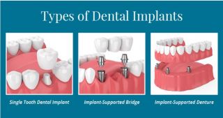 dental implants periodontist victorville Victor Valley Dental Group
