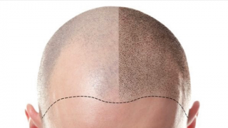 hair replacement service victorville The SMP Marine (Scalp Micro Pigmentation)